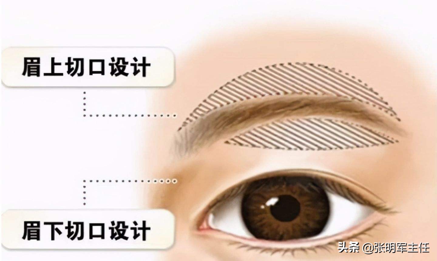 眼皮耷拉、松弛、三角眼，医生建议用两种方法改善