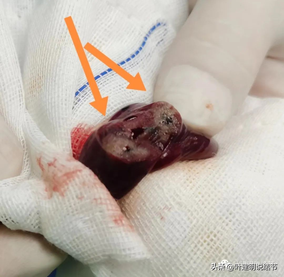 右下叶磨玻璃6mm结节基本上是癌,右下叶少许炎症上叶磨玻璃结节