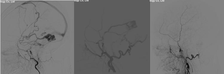 左侧大脑中动脉重度狭窄手术过程,颅内动脉重度狭窄能做手术吗