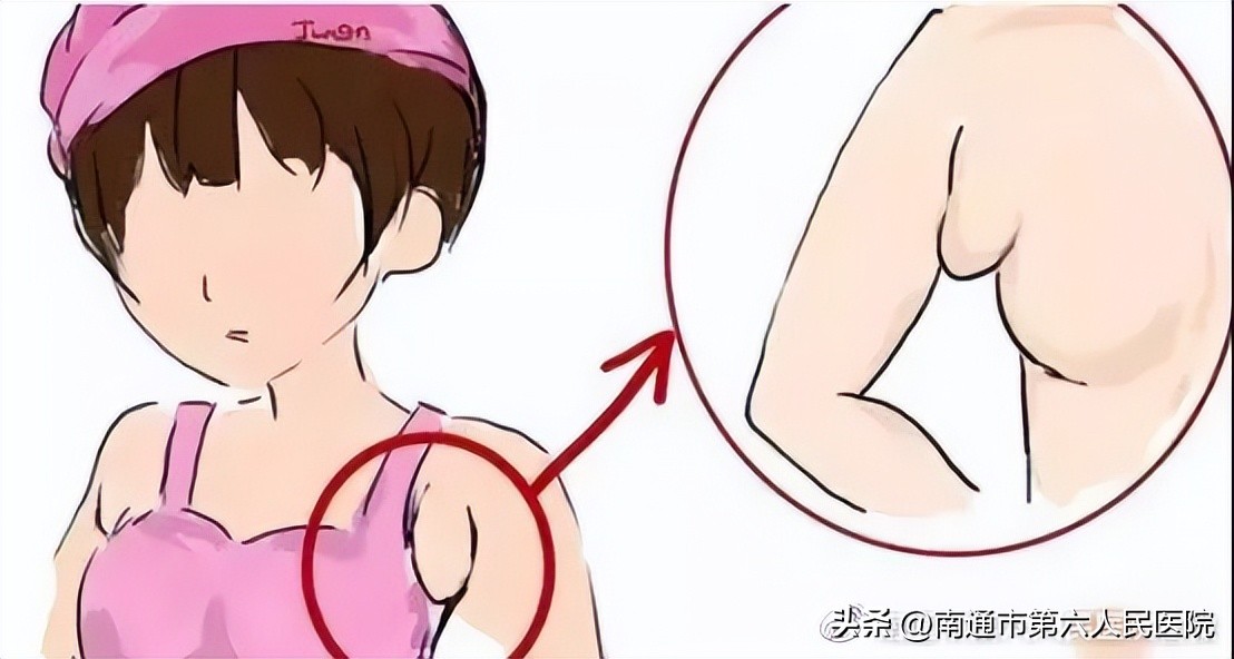 腋窝多了很多小肉粒,腋下有个鸡蛋大的副乳能手术吗