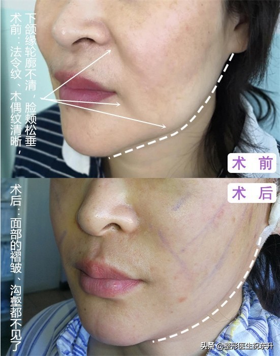 脸上有法令纹用什么方法能去掉,脸上川字纹和法令纹怎么消除