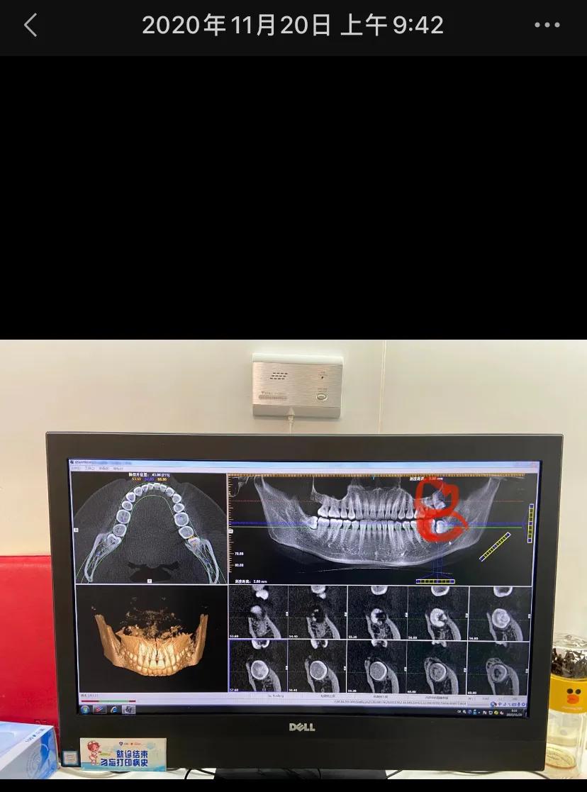 拔除智齿后洞多久愈合,4颗智齿拔掉一颗会怎样