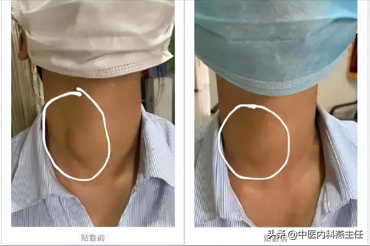 桥本甲状腺结节甲亢应该注意什么,桥本甲状腺结节伴有甲亢怎样治疗