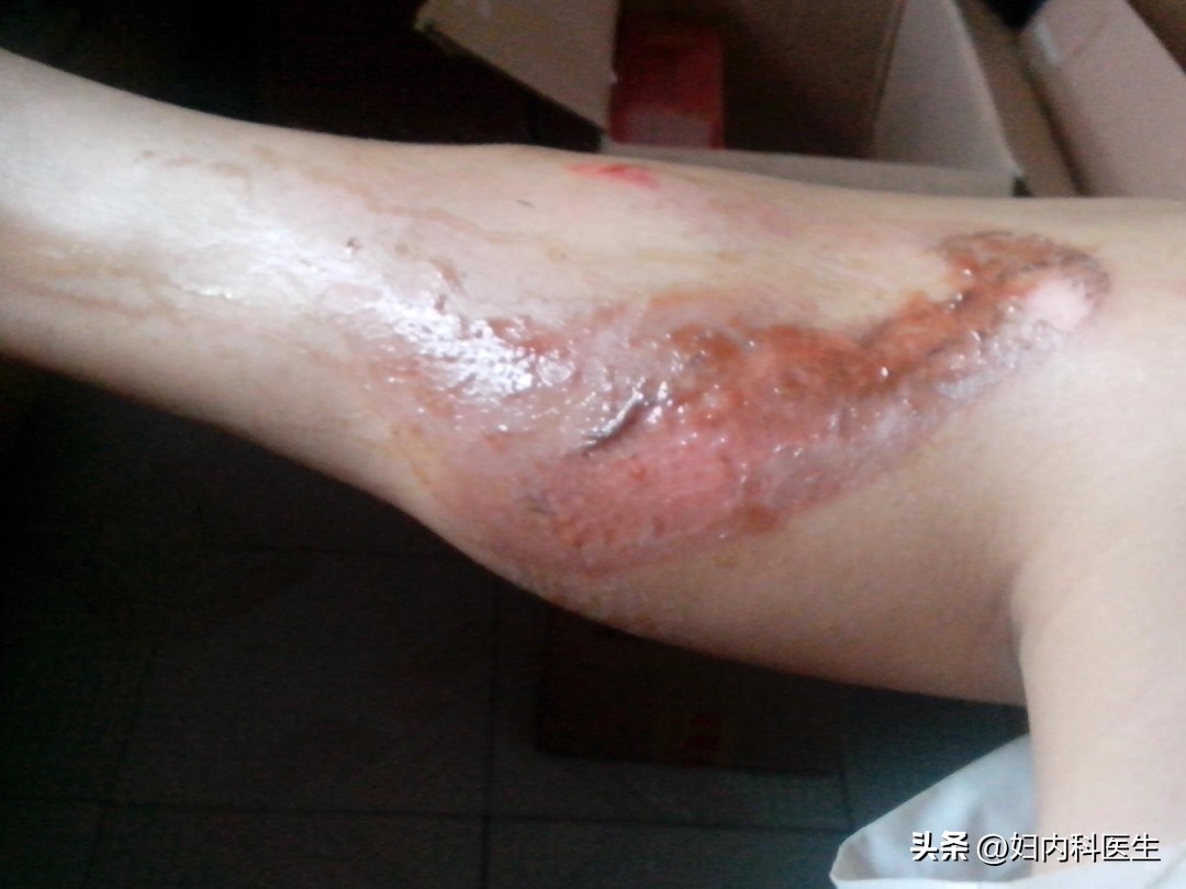 2元钱的红霉素软膏能治疗什么病,2元一支的红霉素功效居然这么多