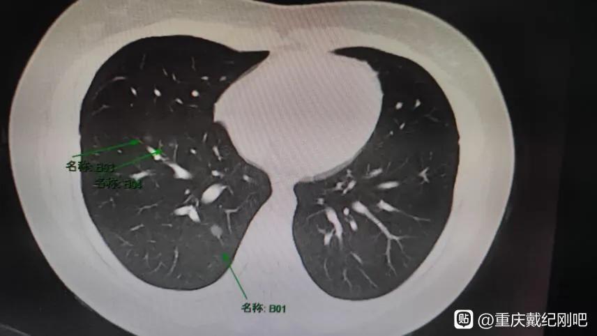 9mm恶性磨玻璃结节肺癌几期,磨玻璃结节8mm同家医院随访8年