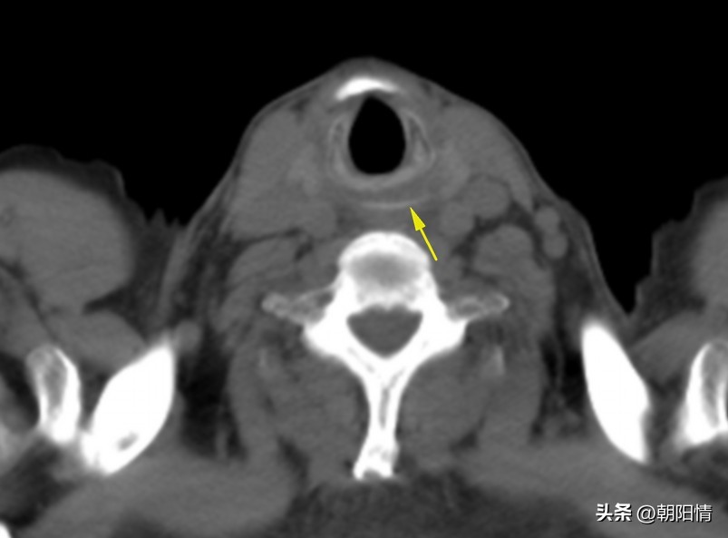消化道异物中医诊断名称,消化道骨性异物