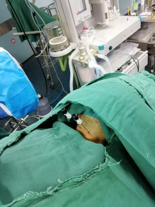 中医解决紧张头痛,中医治疗紧张性头痛