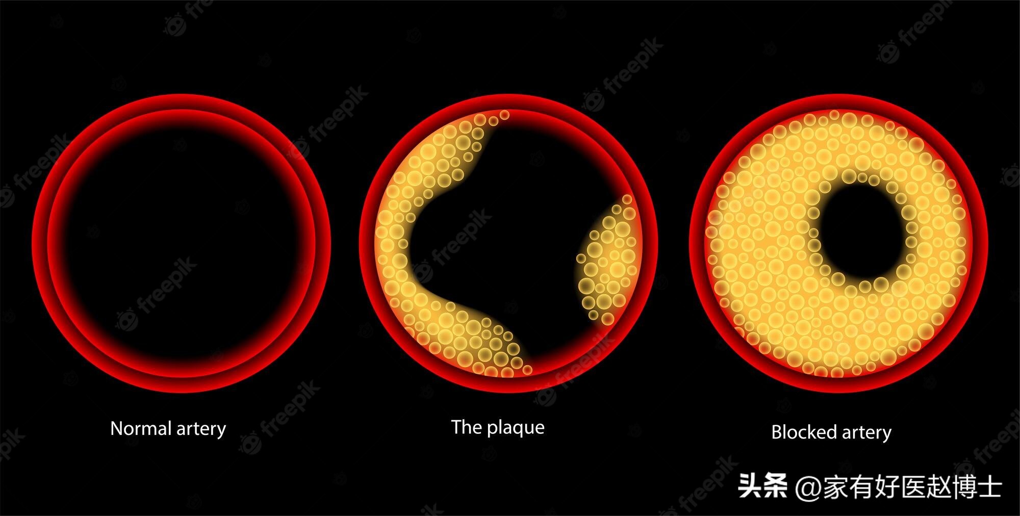 超声检查到的斑块多大才危险,超声检查颈动脉完全闭塞准吗