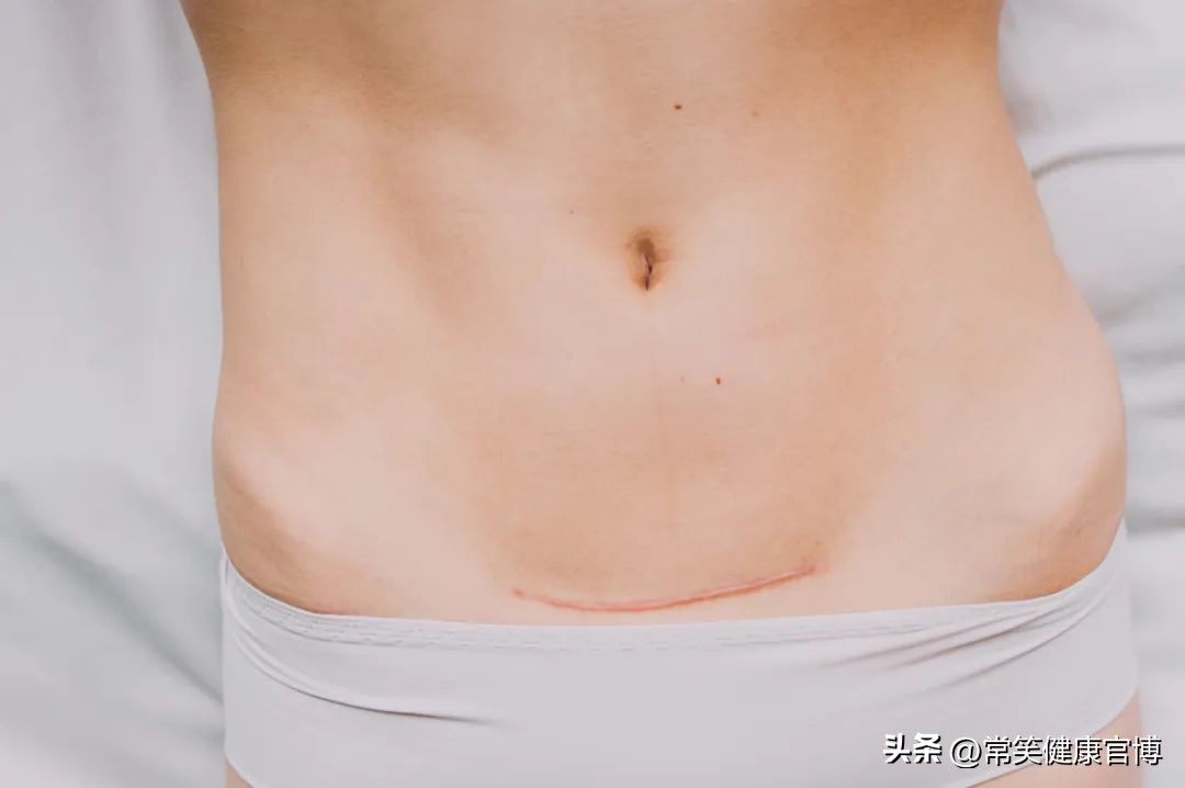 瘢痕妊娠早期有什么症状吗,孕中期瘢痕妊娠有哪些症状