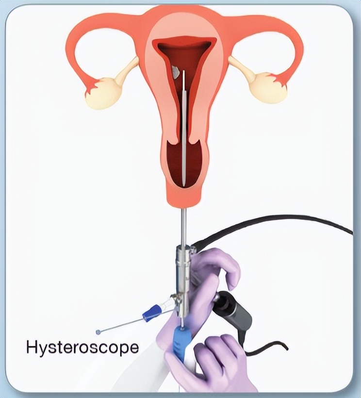 妇科宫腔镜和腹腔镜有什么区别,腹腔镜和宫腔镜的区别是什么