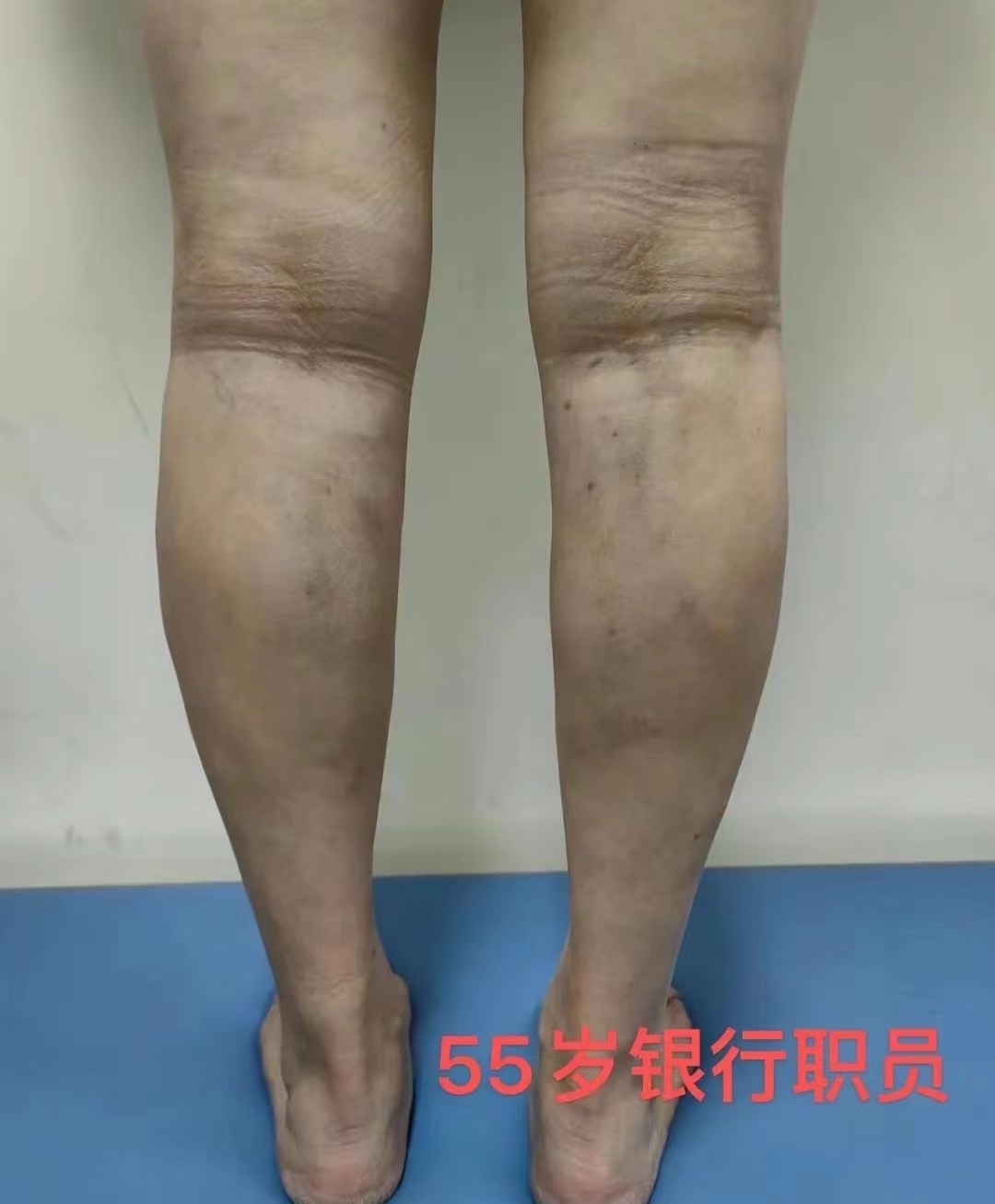 静脉曲张专家杨希亭：早期静脉曲张有哪些方法可以避免症状加重？