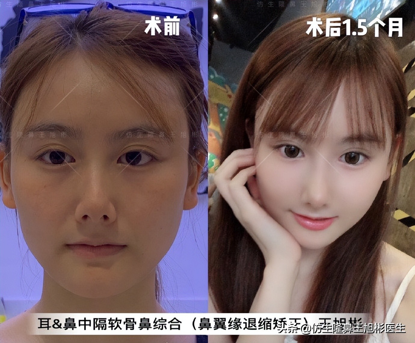 王旭彬：朝天鼻、露鼻孔，模特菲菲短鼻矫正手术后1.5个月