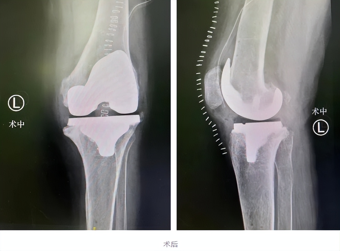 不死的癌症指的是哪种症状,不死的癌症有多可怕