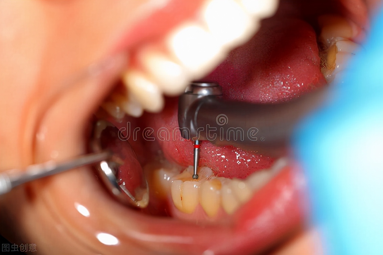 教你一招去除牙结石,牙菌斑牙结石怎么去