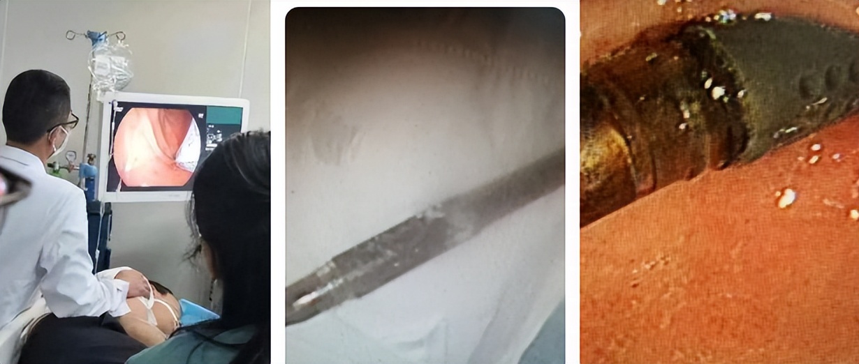 患者吞下15cm“中性笔”星元医院医生耗时3小时成功将其取出