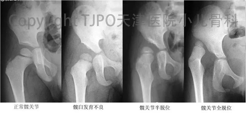 髋关节发育不良做完截骨术,髋关节发育不良截骨矫正能撑多久