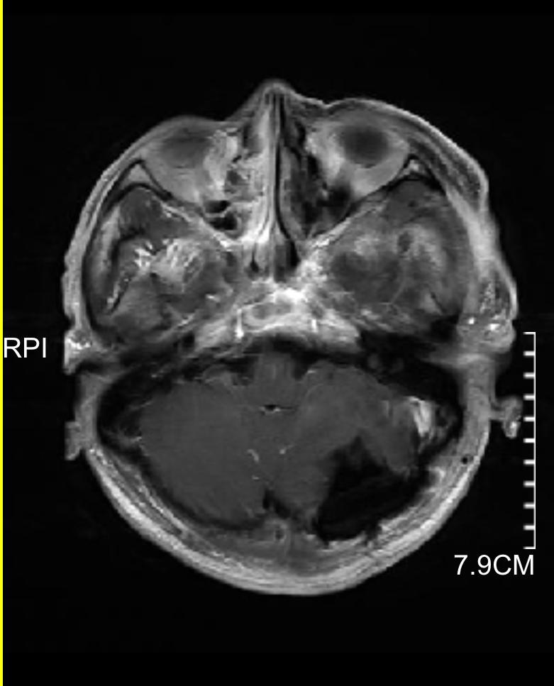 发现脑肿瘤怎么办,发现脑卒中前兆怎么办