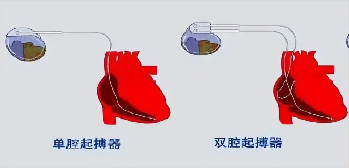 心跳比一般人慢,心跳慢如何锻炼