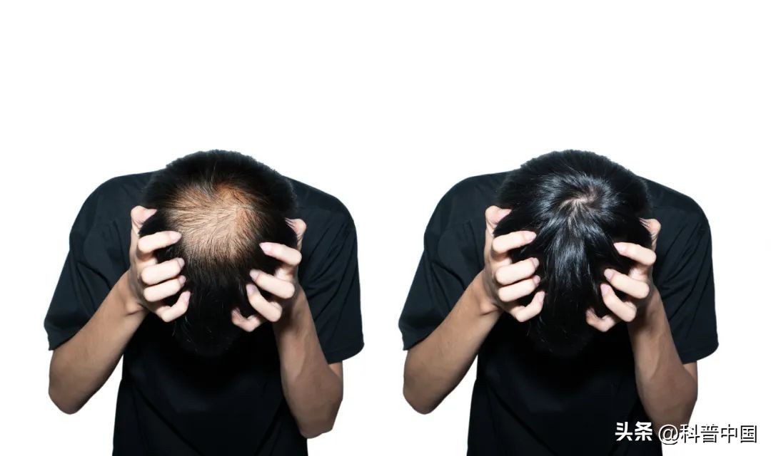 最近总是掉头发是怎么回事,老是掉头发是身体出现问题吗
