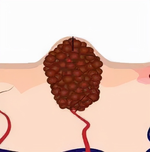 如何区别黑痣和黑色素瘤,怎么分清是黑色素瘤还是黑色的痣