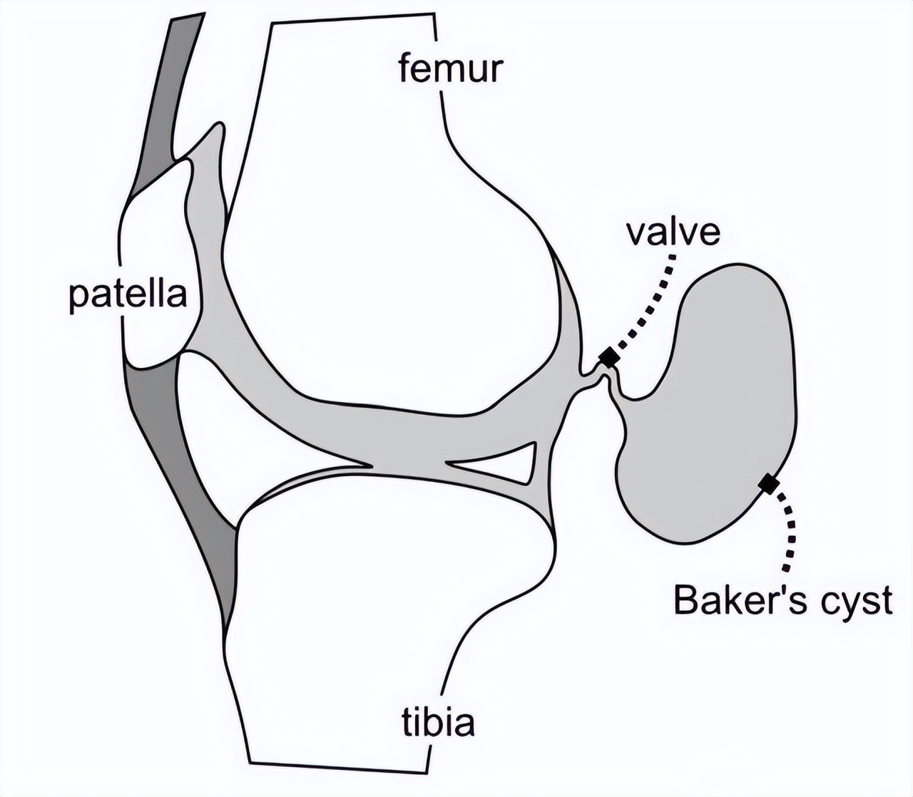 腿弯长了个包？小心是腘窝囊肿