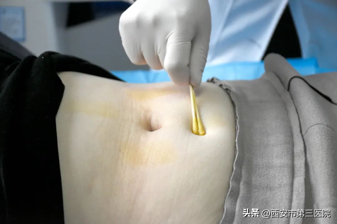 腹部穴位埋线减肥有效果吗,穴位埋线减肥一斤不减