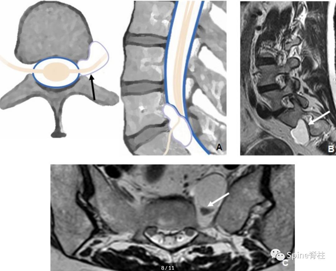 腰椎椎管有囊性结构,水平椎管内囊性占位