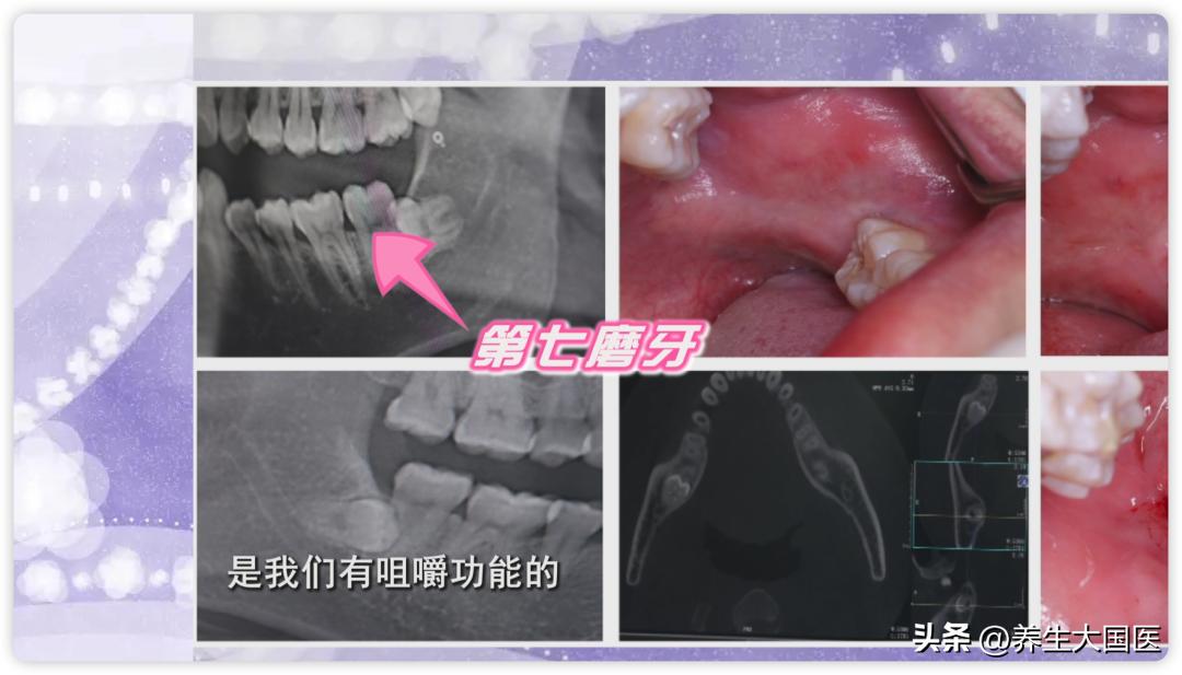 智齿到底用不用拔后悔现在才知道,智齿到底用不用拔专家告诉你答案