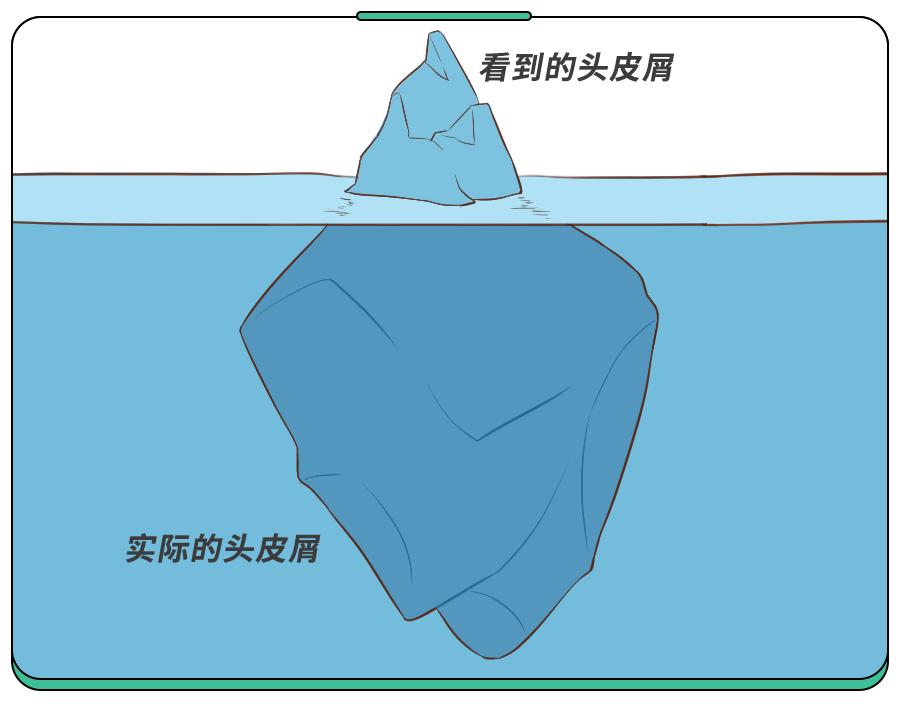 头皮屑是不是因为洗发水的原因,头皮屑多掉发和洗发水有关吗