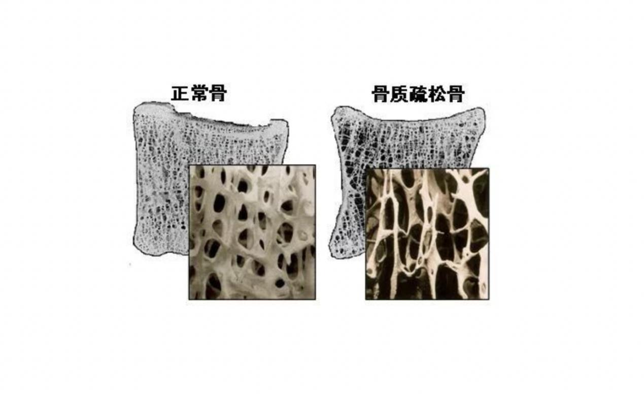 64岁香港特首摔倒骨折，老年人骨折做好2件事，还要补8种食物