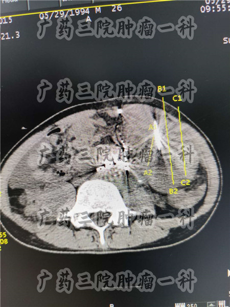 直肠腺癌lla手术能治愈吗,直肠腺癌手术是大手术吗
