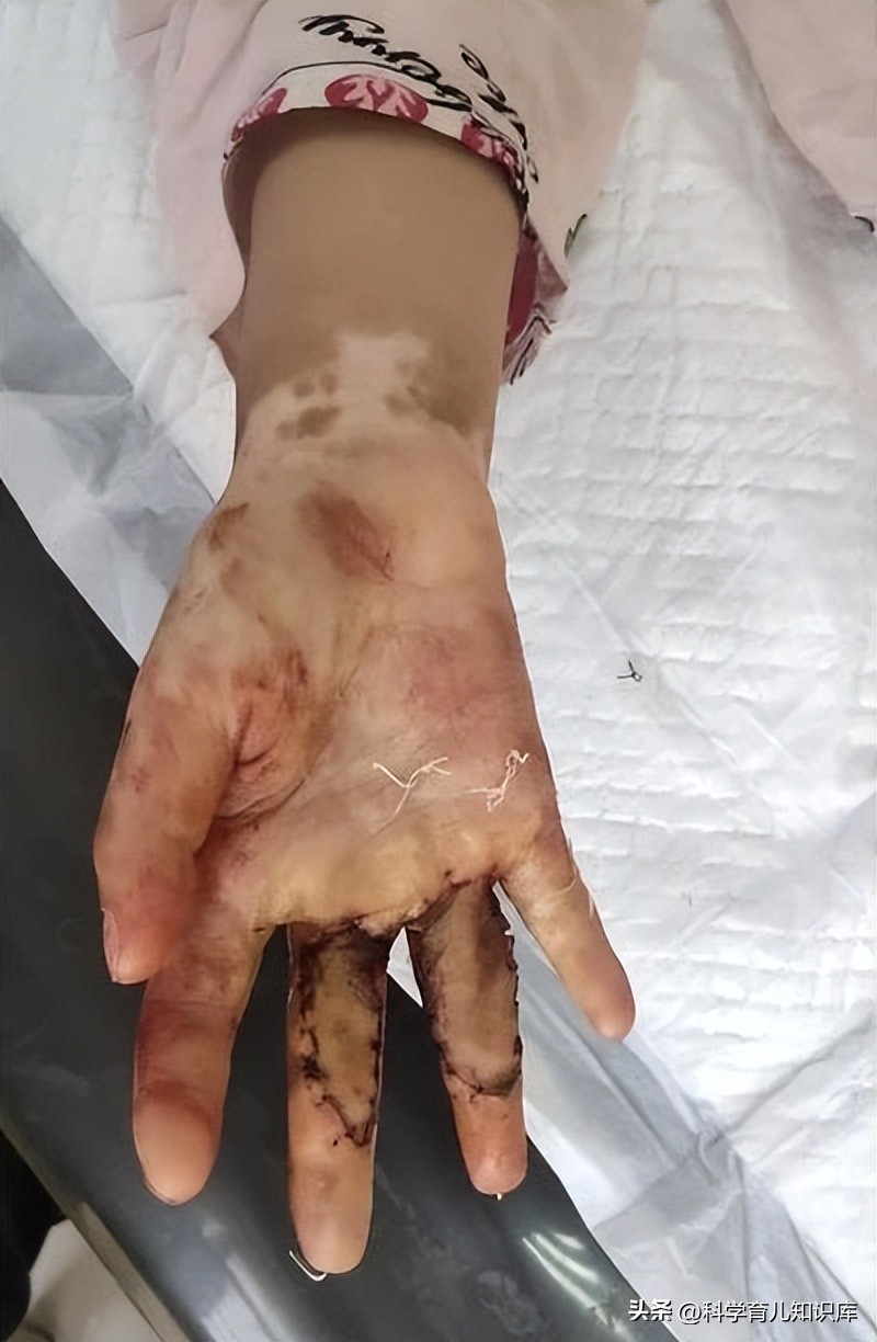 黑心后妈虐待孩子被保姆发现,继母虐待三岁女童