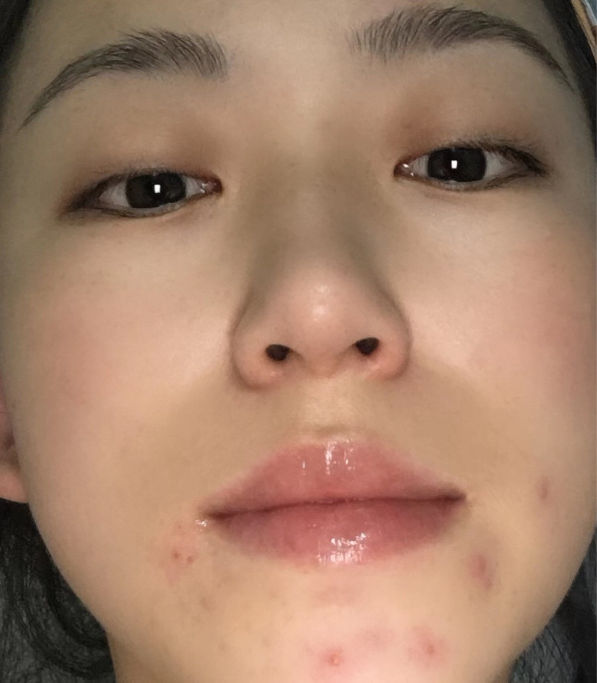 下巴总长痘痘抹什么药,下巴总长痘痘和闭口怎么办