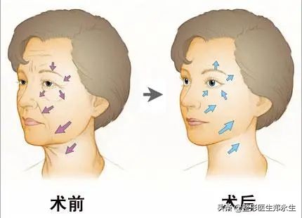 眶周治疗,眶周水肿的处理