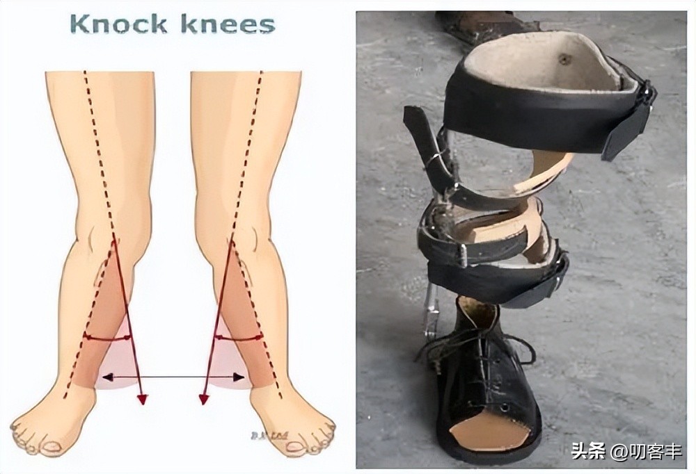 矫正x型腿最快的方法,孩子的x型腿如何矫正