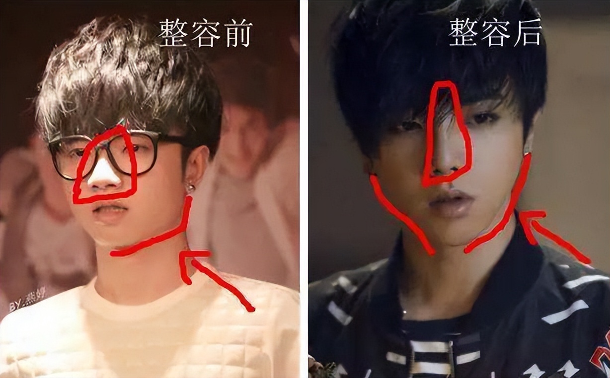 怎么不整容就能成为小v脸,不用整容也能变v脸吗