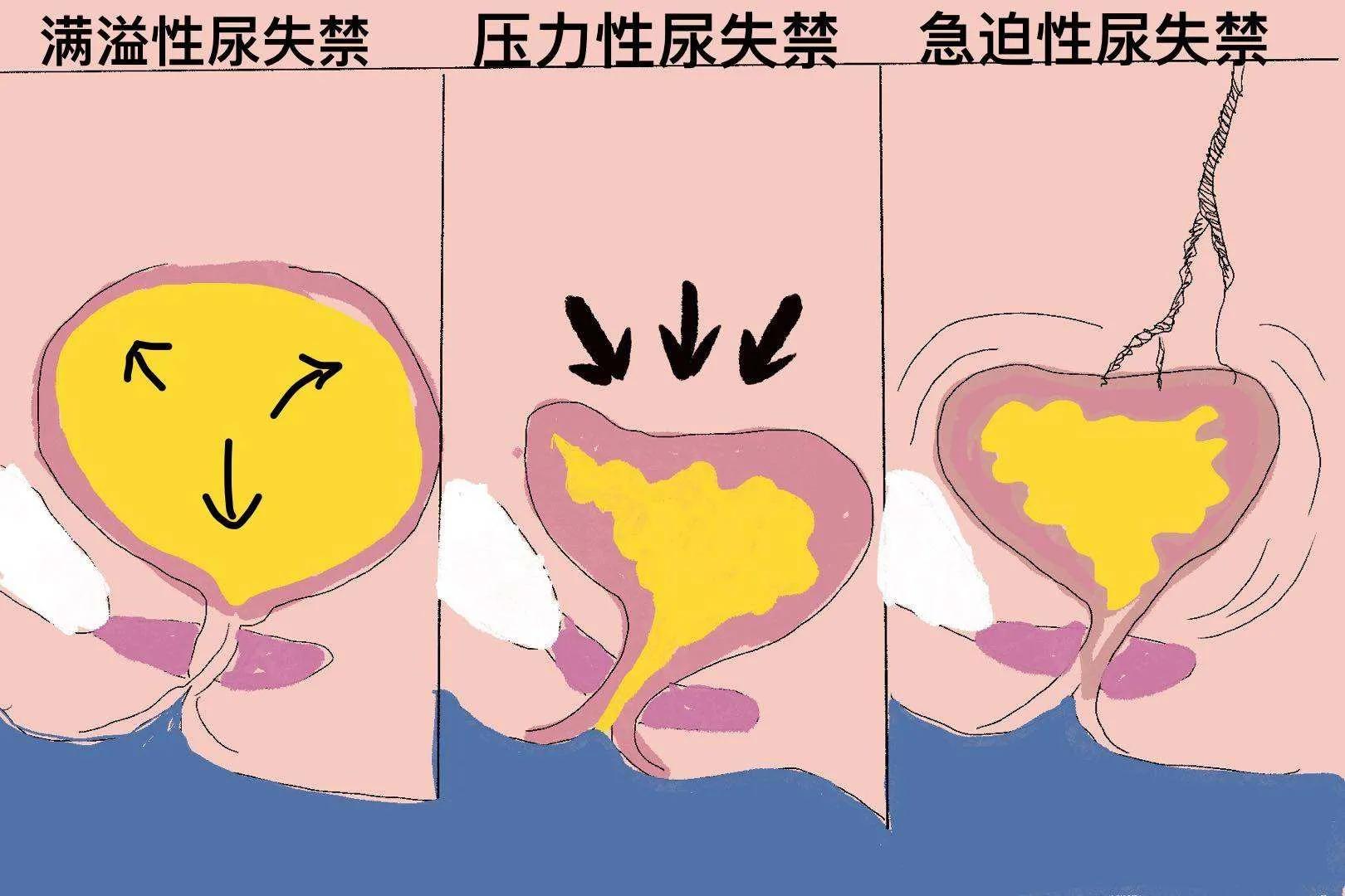 跳绳大笑咳嗽会漏尿是怎么回事,大笑和跳绳会漏尿怎样解决