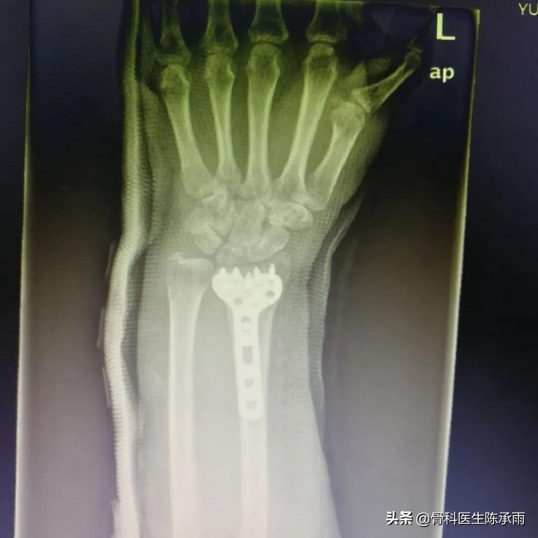 桡骨远端骨折累及关节面保守治疗,桡骨骨折保守还是手术