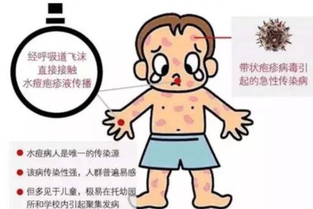 学校水痘爆发的防控措施,学校水痘感染防治要求