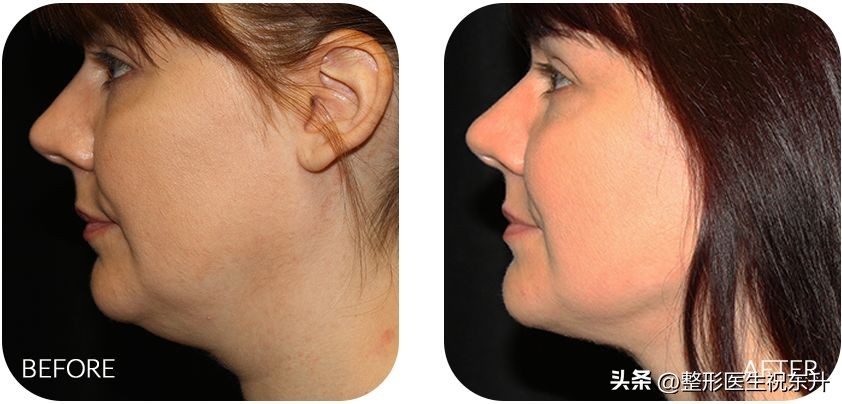 不让颈纹出卖年龄3招有效防颈纹,颈纹太深了怎么消除