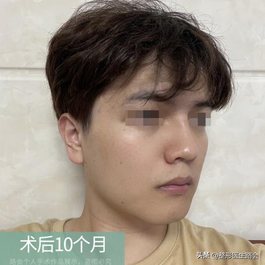 花了几万块钱做的鼻子,花上百万做鼻子