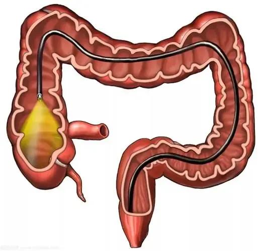 肠长了息肉会有啥症状,肠内为什么容易长息肉