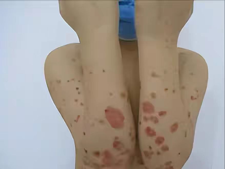 牛皮癣起红斑凸起是不是很严重,身上长牛皮癣的地方发黑发紫