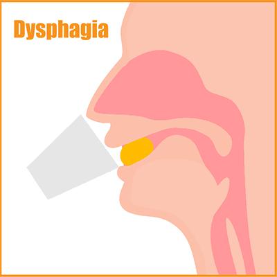 脑出血后吞咽呛咳能治好吗,脑梗喝水呛咳吞咽困难是什么原因