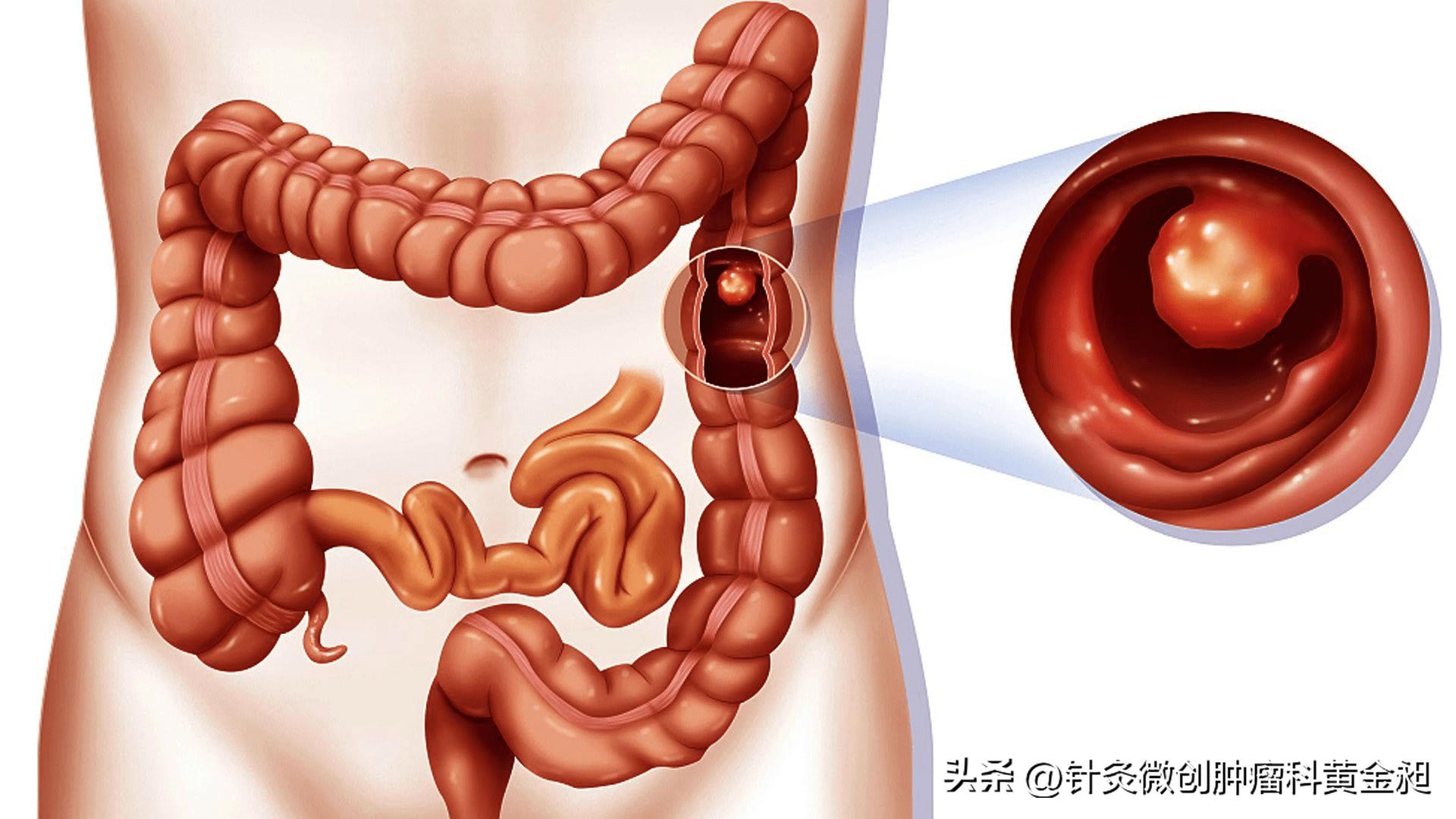 【病案分享】直肠癌康复——中医来助力
