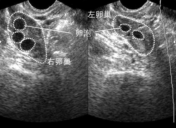 怀上八胞胎的郑州女子,郑州女子怀上八胞胎后续