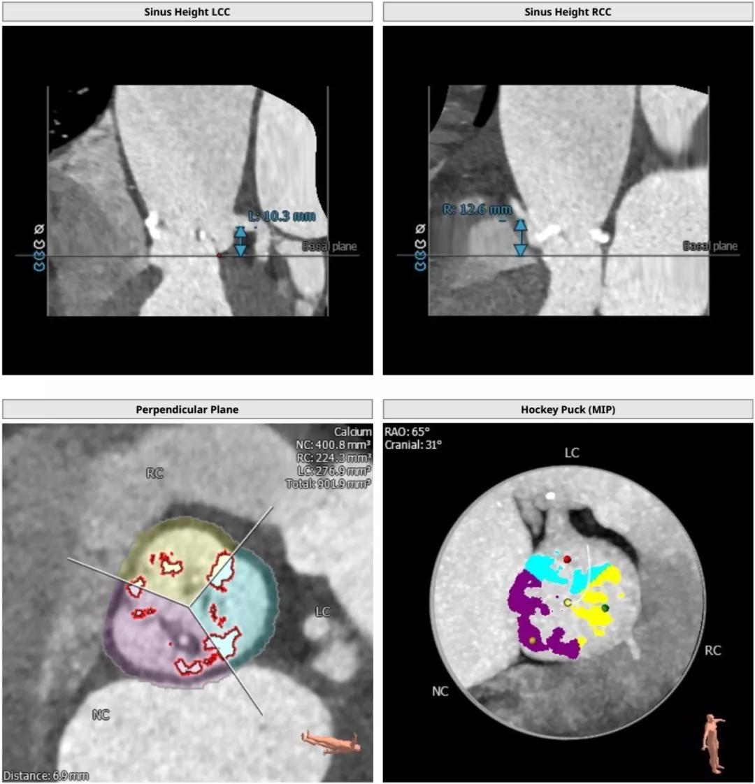 主动脉瓣狭窄病例讨论,25岁主动脉瓣狭窄用什么治疗方案