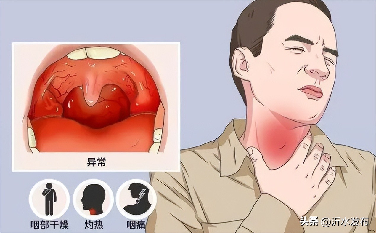 五一后嗓子疼是新冠二阳吗,新冠阳性后慢性咽喉炎怎么办