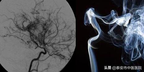 硬核技术!*安泰**市中医医院成功完成本院首例颅内外血管搭桥手术