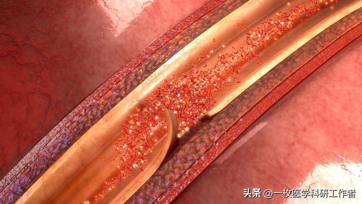 高血压高血脂动脉硬化是基础病吗,高血脂会引起主动脉夹层吗